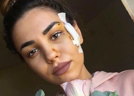 Mira a vorbit pentru prima dată despre accident: ”M-am ales cu răni…”
