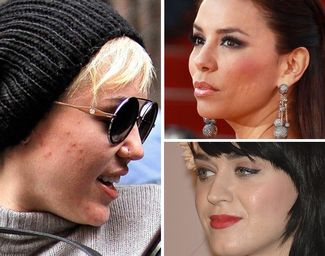 14 superstaruri care au suferit de acnee, dar acum au un ten fabulos